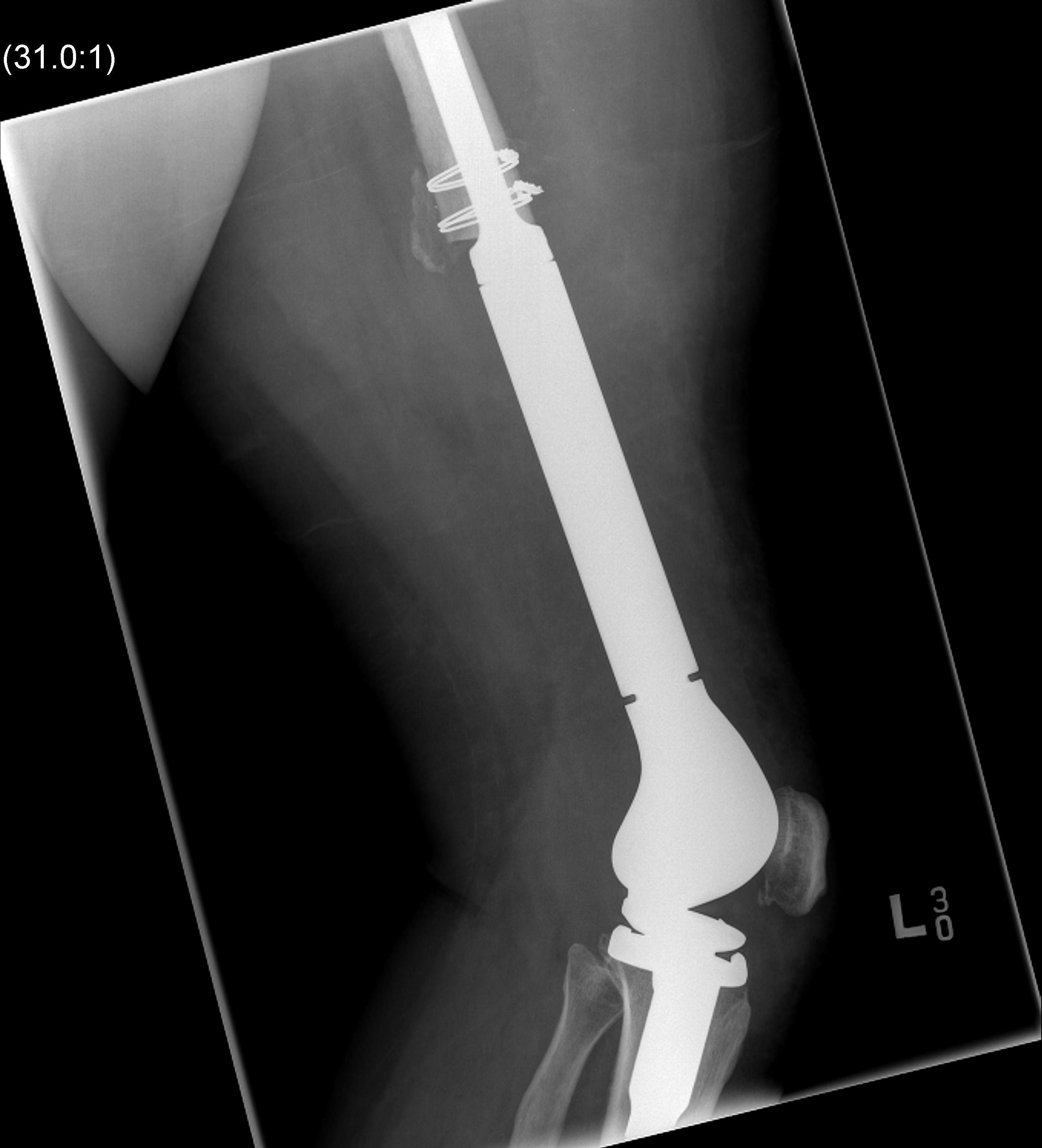 Osteosarcoma Distal Femur Tumour Prosthesis0001